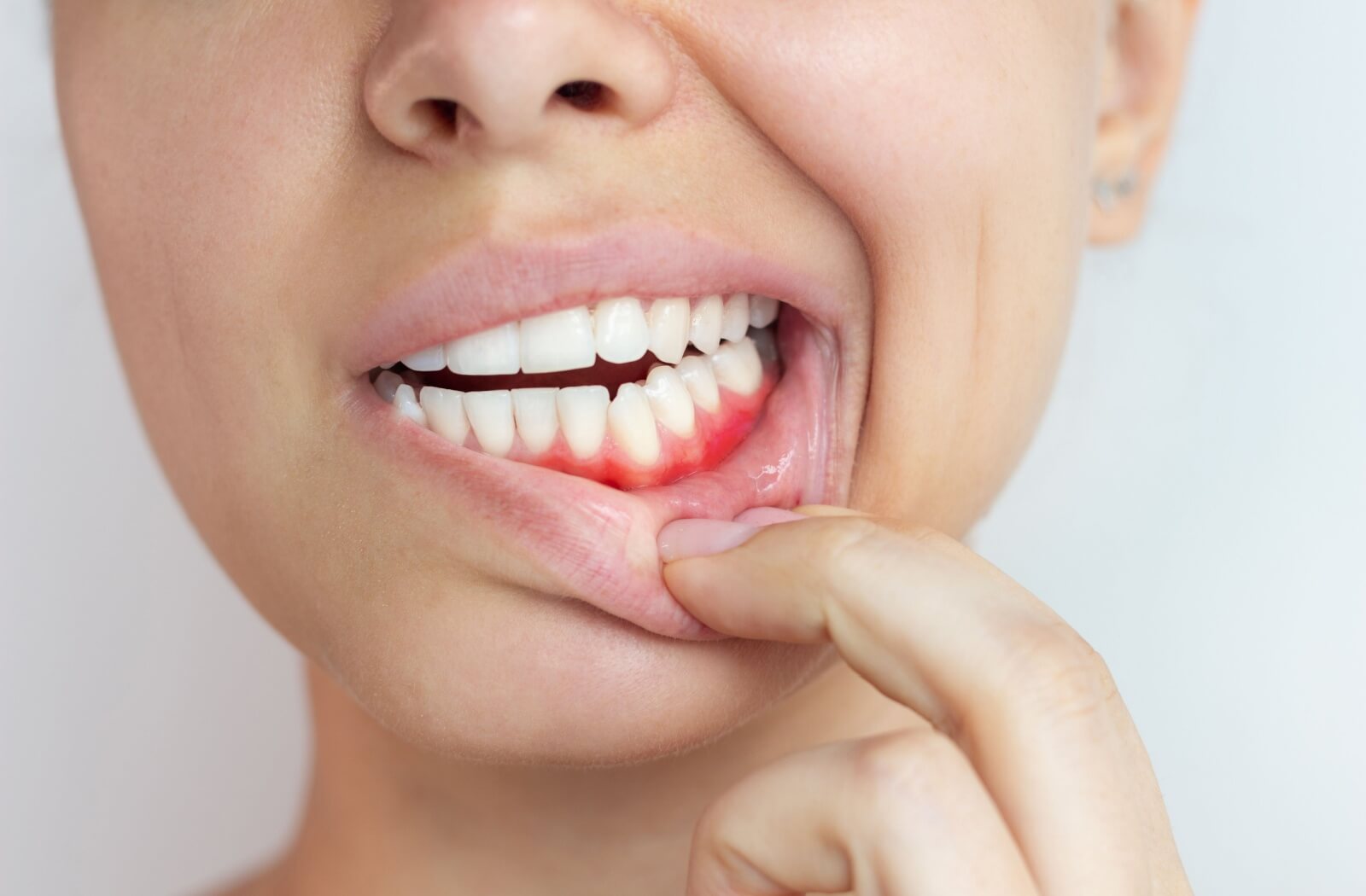 A person pulling their bottom lip down to show their gums, which are red and inflamed because of gingivitis.